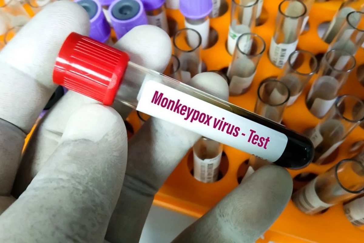 ÜST Azərbaycana meymunçiçəyi test dəstləri verdi