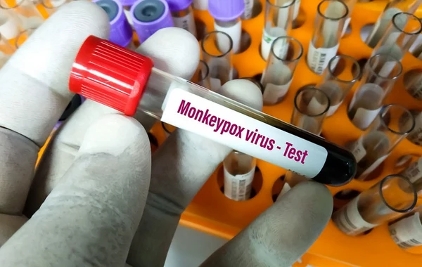 ÜST Azərbaycana meymunçiçəyi test dəstləri verdi