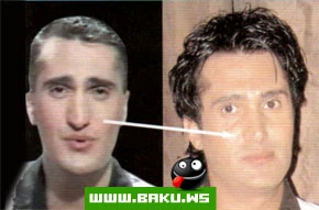 Azerbaycanda Plastik Emeliyyat
