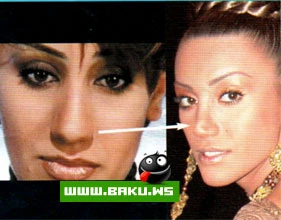 Azerbaycanda Plastik Emeliyyat