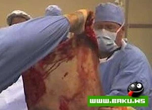 “Dağ adam” 272 kq arıqladı