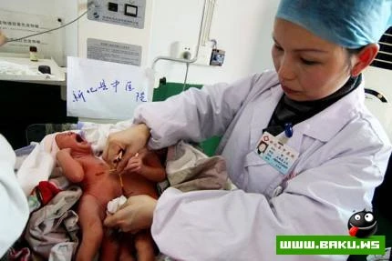 Siam ekizlerinin bolunmesi emeliyyati