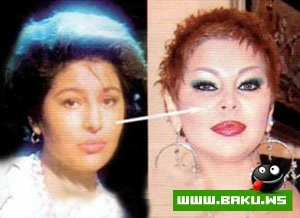 Şou-biznesimizin plastik əməliyyat keçirən simaları - 30 FOTO