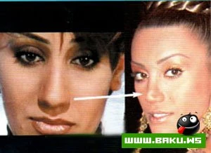 Şou-biznesimizin plastik əməliyyat keçirən simaları - 30 FOTO