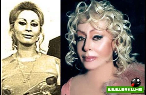 Azərbaycan ulduzları plastik əməliyyatlardan əvvəl və sonra