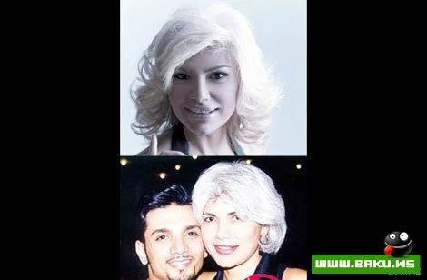 Azərbaycan ulduzları plastik əməliyyatlardan əvvəl və sonra