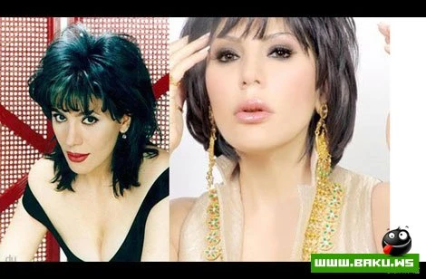 Azərbaycan ulduzları plastik əməliyyatlardan əvvəl və sonra