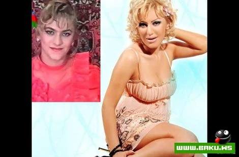 Azərbaycan ulduzları plastik əməliyyatlardan əvvəl və sonra
