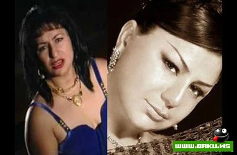 Azərbaycan ulduzları plastik əməliyyatlardan əvvəl və sonra