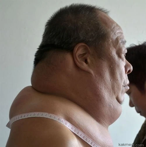 Бедняк, у которого шея шире, чем плечи