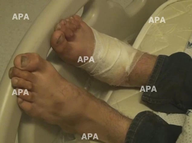 В Азербайджане юношу укусила змея