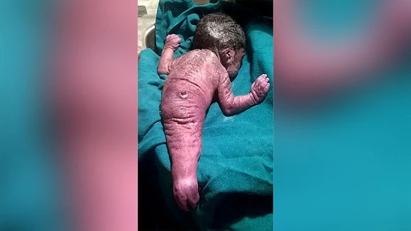 В Индии женщина родила русалкоподобного ребенка (фото)