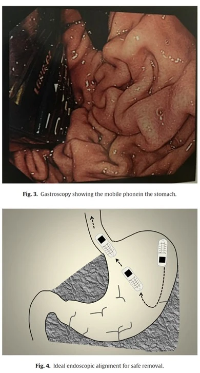Cib telefonunu udan məhbus həkimləri şoka saldı (VİDEO, FOTO)