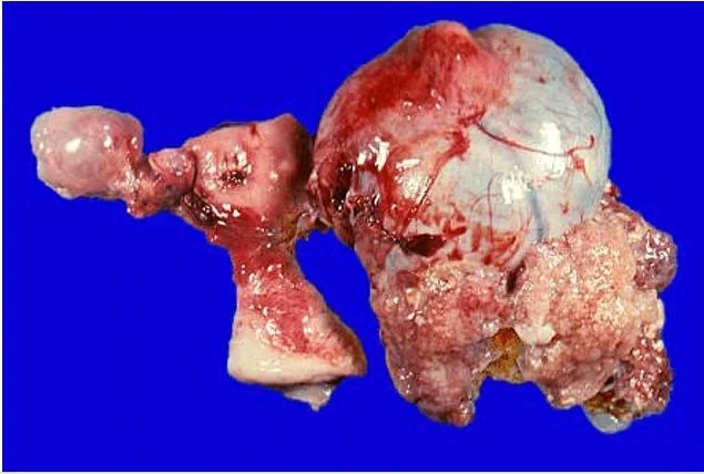 Həkimlər şokda: 16 yaşlı qızın yumurtalığından görün nələr çıxdı (FOTO)