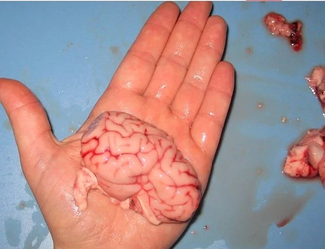 Həkimlər şokda: 16 yaşlı qızın yumurtalığından görün nələr çıxdı (FOTO)