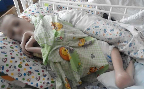 Dünyanı şoka salan hadisə - 20 yaşındakı qız 11 kq çəkiyə düşdü (FOTO)