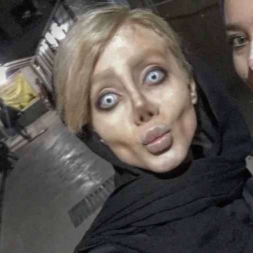 Ancelina Coliyə oxşamaq istəyən 19 yaşlı iranlı qız qorxulu vəziyyətə düşdü (FOTO)
