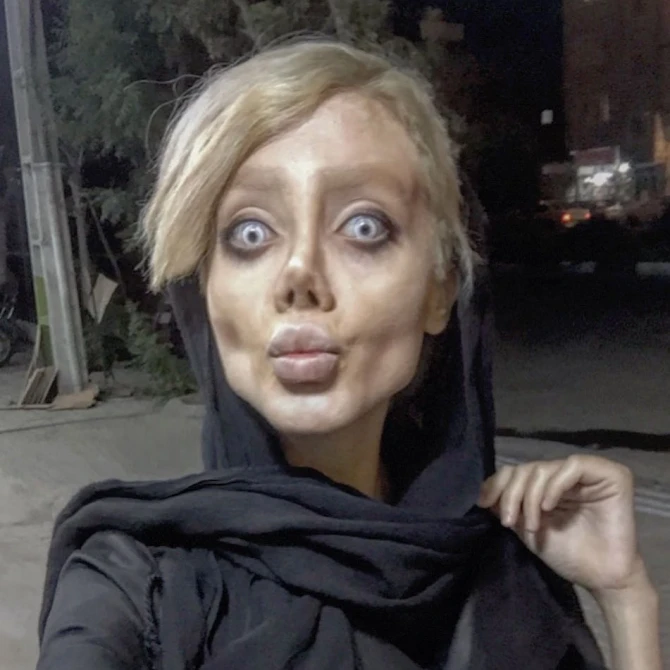 Ancelina Coliyə oxşamaq istəyən 19 yaşlı iranlı qız qorxulu vəziyyətə düşdü (FOTO)