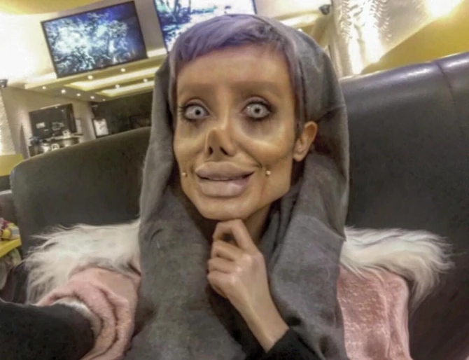 Ancelina Coliyə oxşamaq istəyən 19 yaşlı iranlı qız qorxulu vəziyyətə düşdü (FOTO)