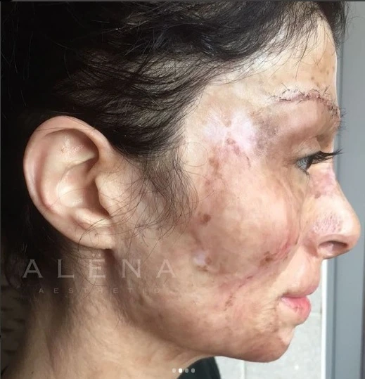 Məşhur futbolçunun model həyat yoldaşı üzü yanmış qıza, köməklik əlini uzatdı (FOTO)