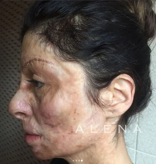 Məşhur futbolçunun model həyat yoldaşı üzü yanmış qıza, köməklik əlini uzatdı (FOTO)