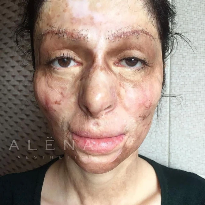 Məşhur futbolçunun model həyat yoldaşı üzü yanmış qıza, köməklik əlini uzatdı (FOTO)