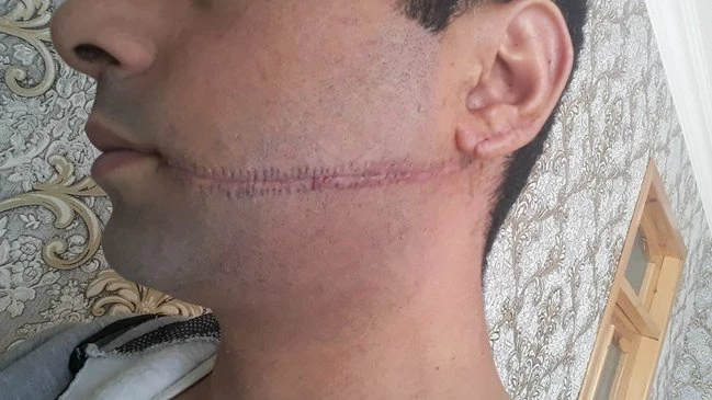 Azərbaycanda DƏHŞƏTLİ CİNAYƏT: 26 yaşlı gəncin ağzını kəsdilər - FOTO