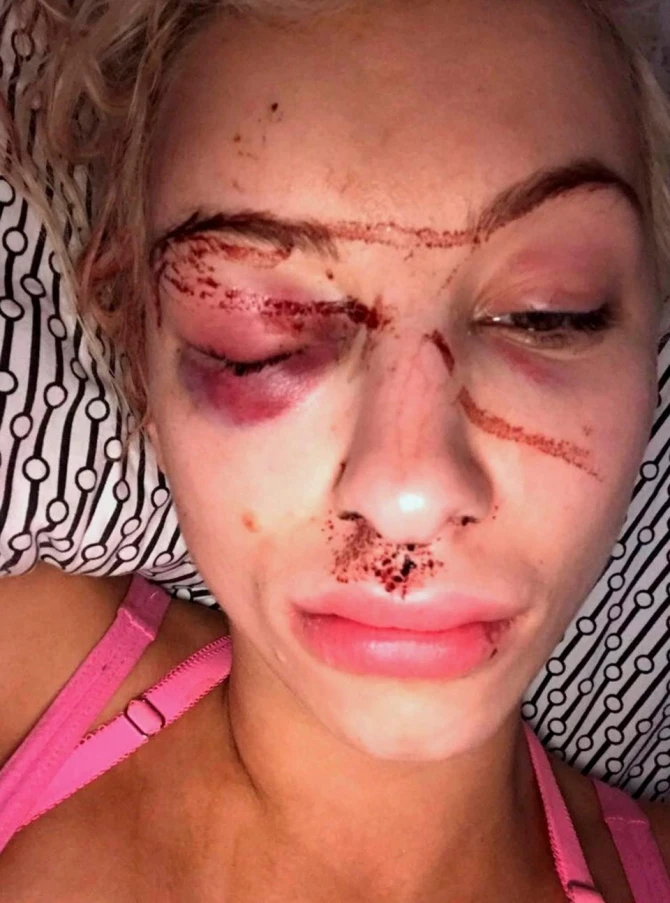 Model sevgilisi tərəfindən vəhşicəsinə döyüldü - FOTO