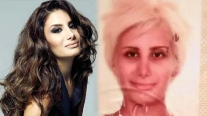 Tanımaq mümkün deyil - Türkiyəli məşhurlar estetik əməliyyatdan öncə - FOTOLAR