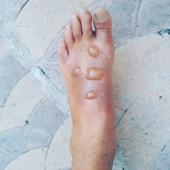 Reper Cin ayağını yandırdı  (+18 FOTO)