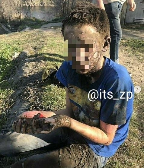 Подросток остался жив после удара током в 10 тысяч вольт - ФОТО