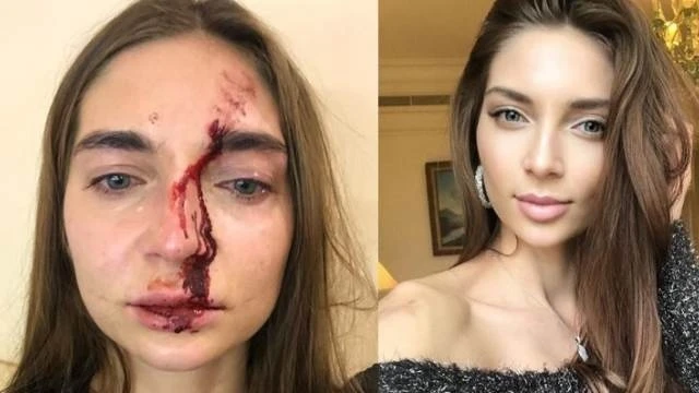 Избитая в московской клинике певица показала сломанный нос и окровавленное лицо - ВИДЕО 
