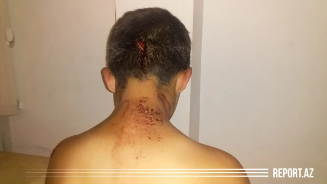 Bakıda DƏHŞƏT - Ata dilənmək istəməyən 11 yaşlı oğlunu başından bıçaqladı - FOTO