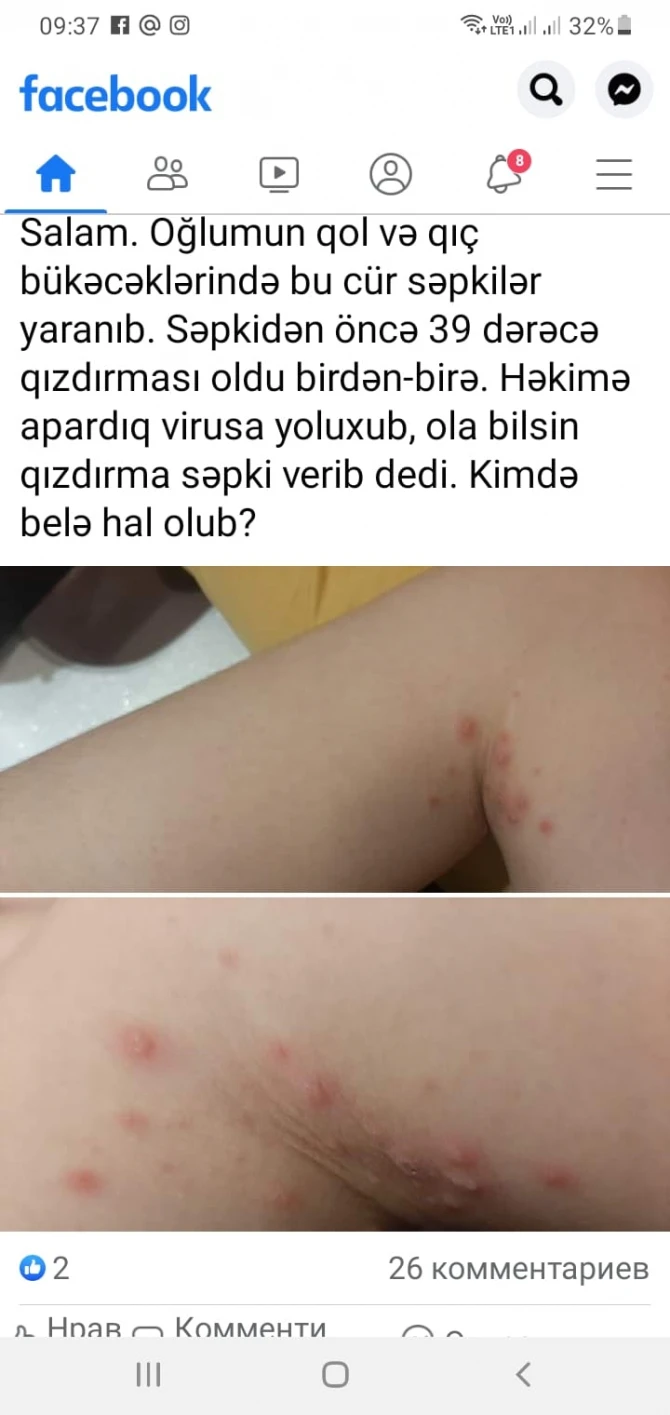 Azərbaycanda uşaqlar arasında yayılan xəstəlik meymunçiçəyidir?  - Professordan VACİB AÇIQLAMA