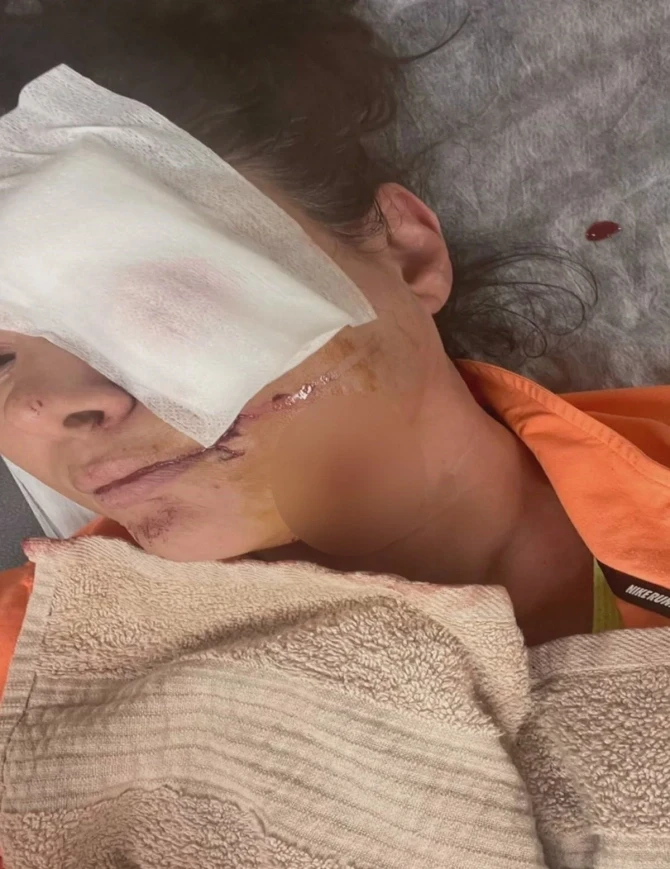 Rafet El Romanın eks arvadına it hücum etdi: Üzünə tikiş atıldı - FOTO