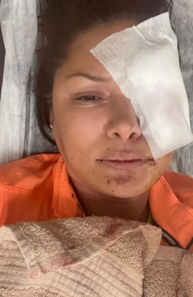 Rafet El Romanın eks arvadına it hücum etdi: Üzünə tikiş atıldı - FOTO