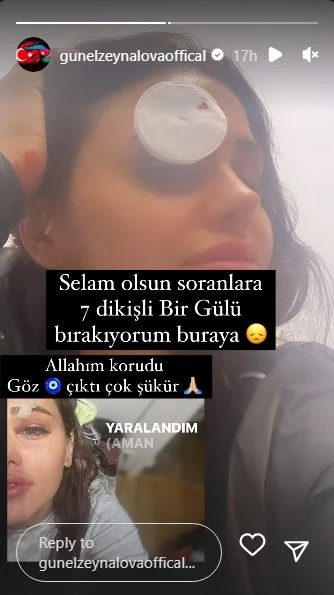 Günel Zeynalovanın qaşına 7 tikiş qoyuldu - FOTO