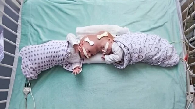 Bitişik doğulan əkizlər 11 saatlıq əməliyyatla ayrıldılar - FOTO