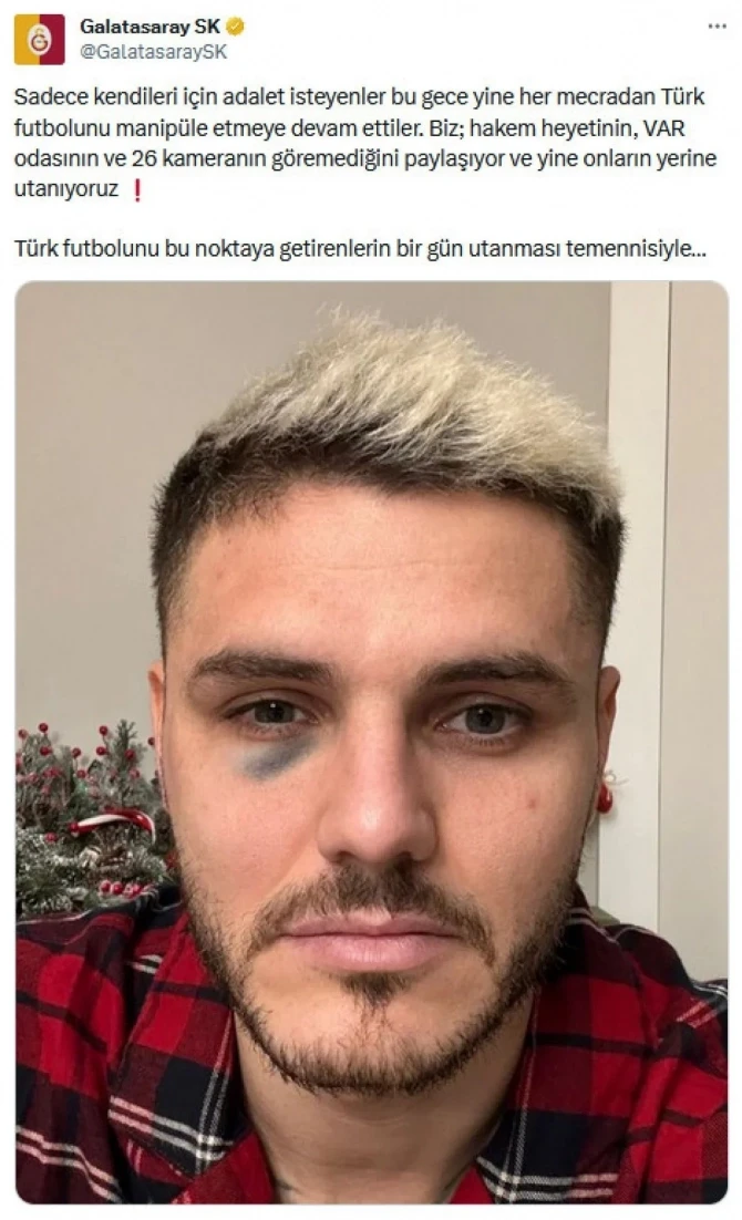 “Qalatasaray” VAR hakimlərini şikayət etdi - İkardinin gözünü dirək yox, yumruq göyərdib - FOTO