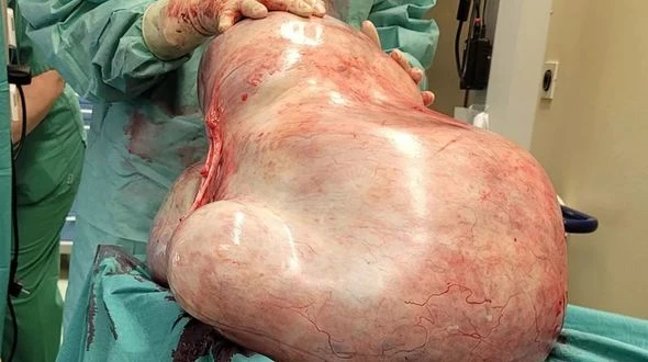 Almaniyada xəstənin bədənindən 32 kq-lıq şiş çıxarıldı - FOTO