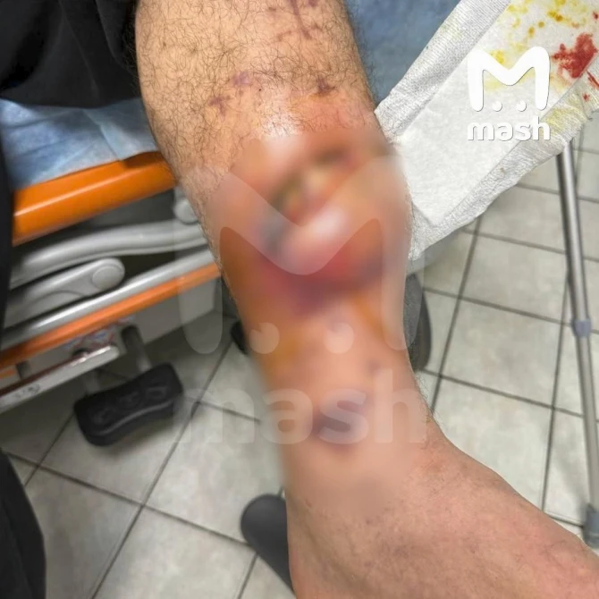 Həbs edilən blogerin ayağı amputasiya oluna bilər - FOTO