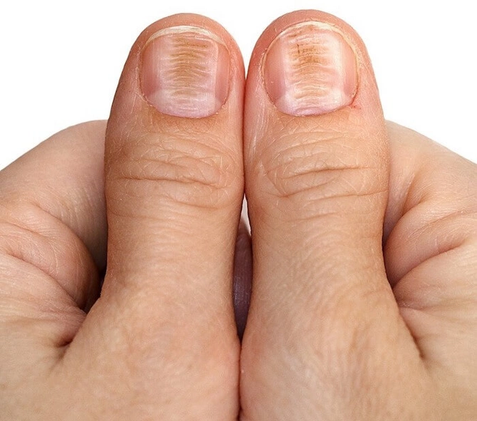 WARNING for those with such lines on their nails - It turns out... WARNING for those with such lines on their nails - It turns out...