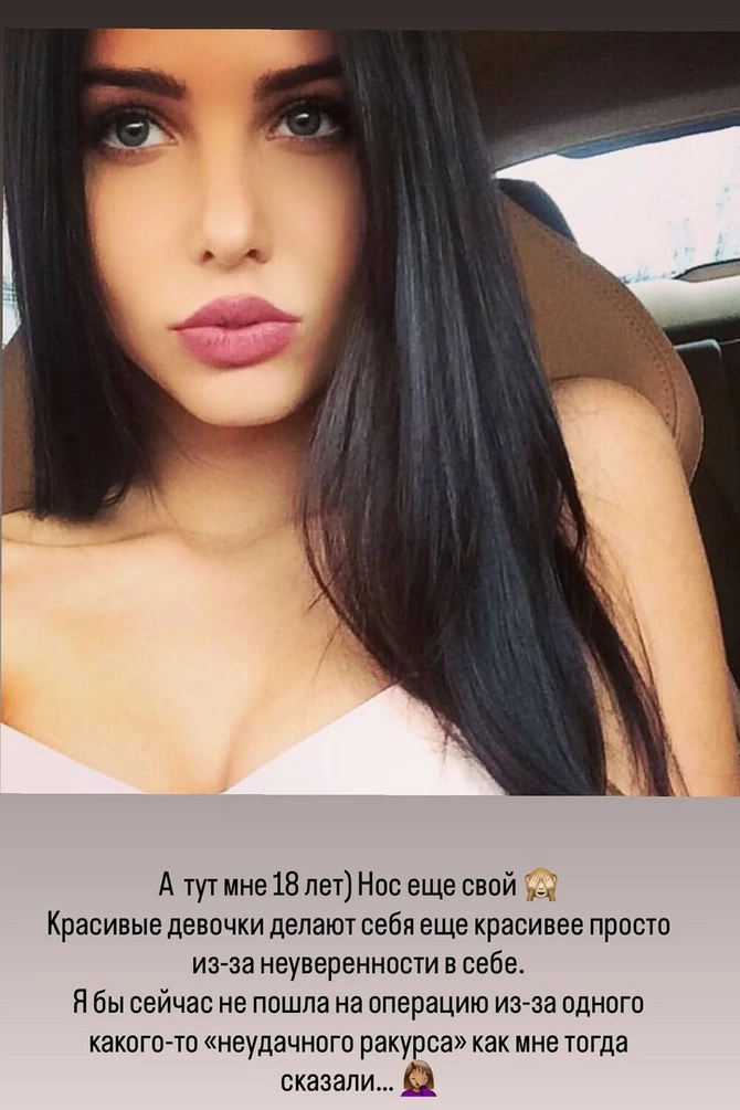 Anastasia Reshetova revealed how she looked before plastic surgery: 