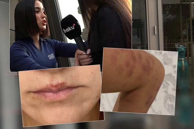 Как лазерная эпиляция в Баку стала опасной игрой: ожог вместо гладкой кожи - реальная история
