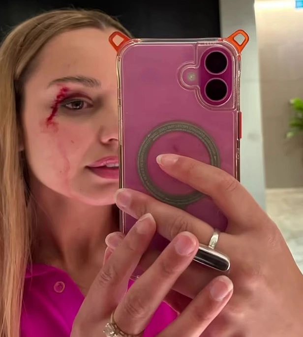 Aparıcı canlı yayımda gözündən zərbə aldı - ANBAAN VİDEO