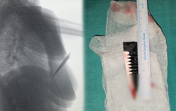 Toydan çıxarkən bıçaqlandı - Davulçu keçmiş sevgilisindən şikayətçidir