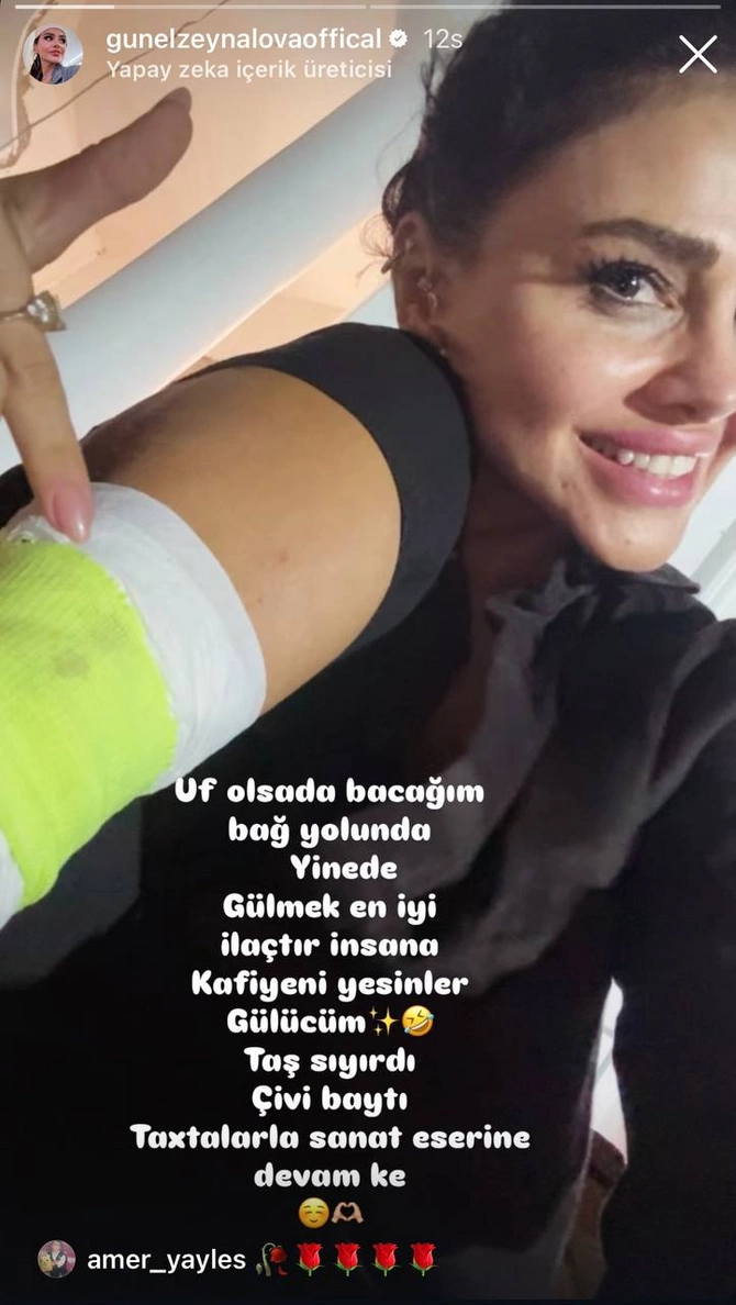 Günel Zeynalovanın başına iş gəldi - Ayağı zədələndi
