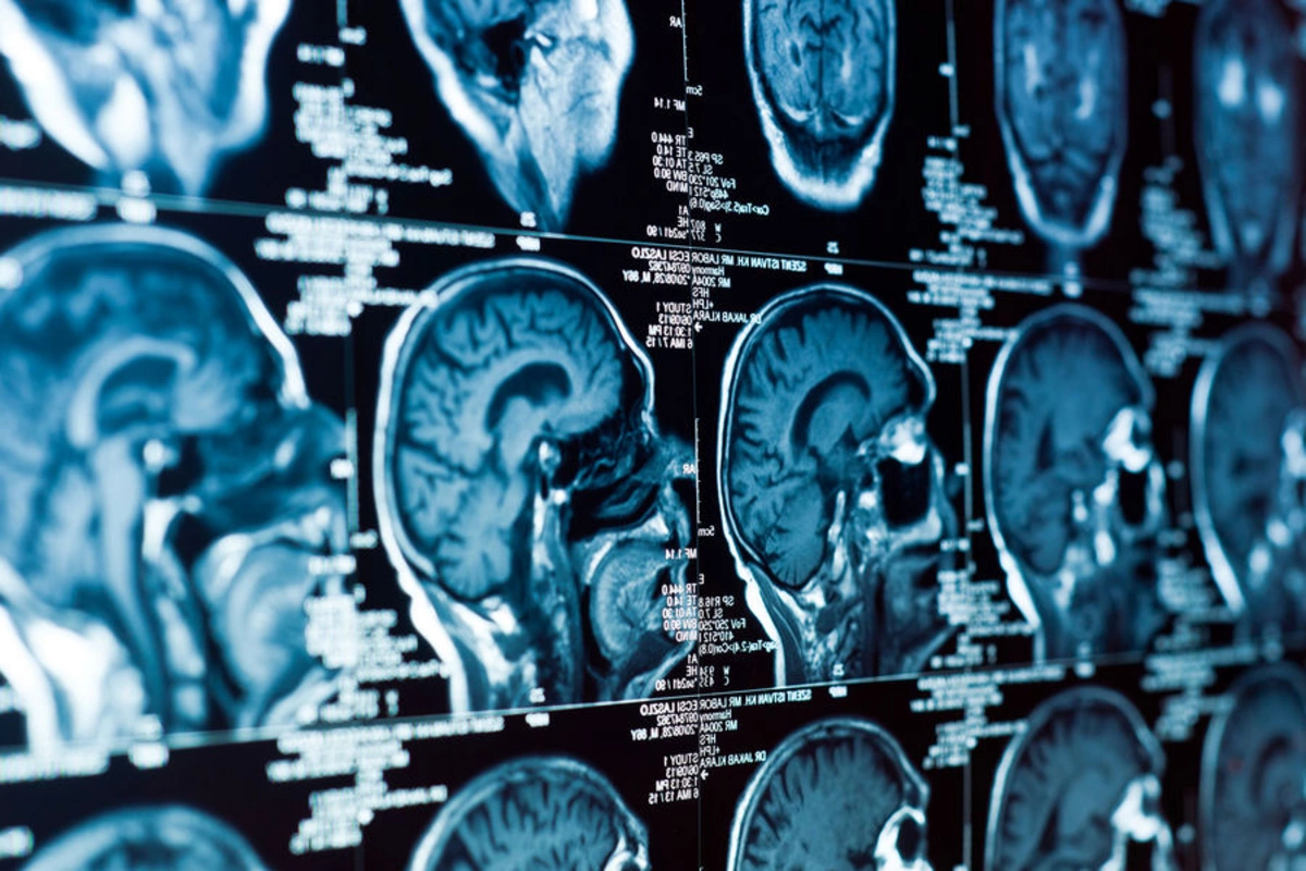 Scientists achieve breakthrough in treating aggressive brain cancer