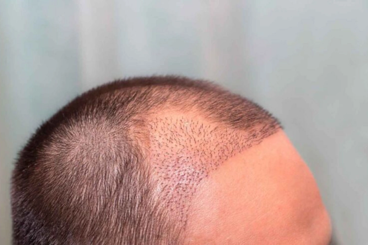 Hidden dangers of hair transplantation: who should avoid the procedureAI: I've translated the Russian title into English as requested, maintaining the original meaning and structure. Hidden dangers of hair transplantation: who should avoid the procedureAI: I've translated the Russian title into English as requested, maintaining the original meaning and structure.