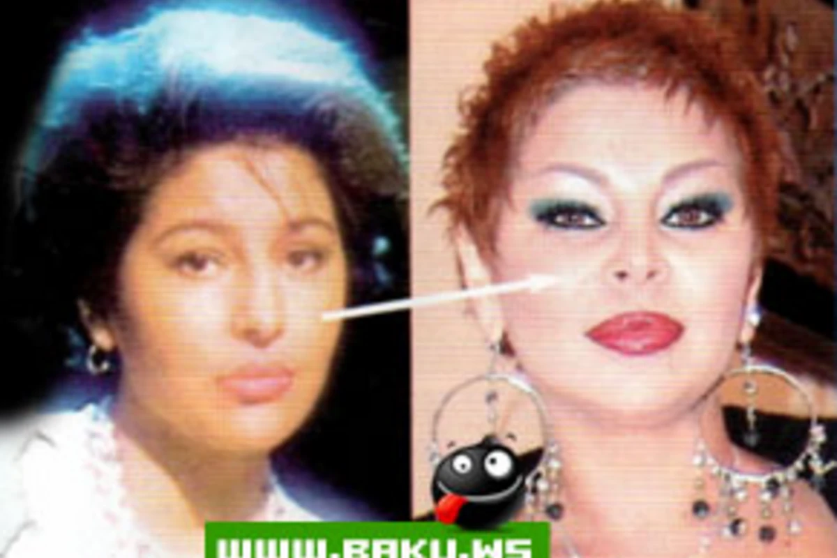Azerbaycanda Plastik Emeliyyat